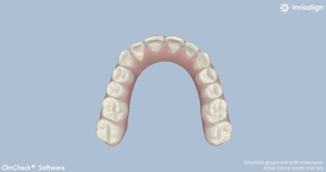 Computer view of completed Invisalign case
