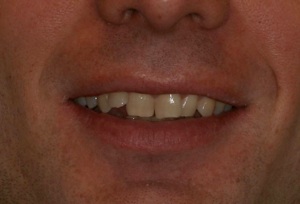 Smile before Invisalign