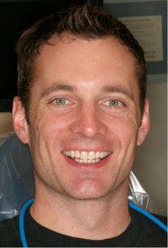 Full face smile after Invisalign treatment