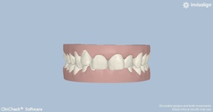 Computer view of this Invisalign patient