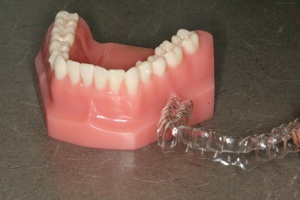 Invisalign aligner next to a model